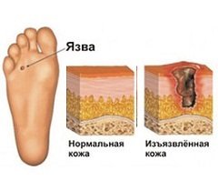 Cukorbeteg lábfej