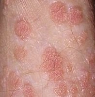Balanoposthitis a férfiak 2