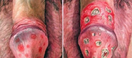 Balanoposthitis a férfiak