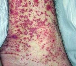 Vasculitis a lábát