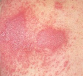 Dermatitisz kezelésére