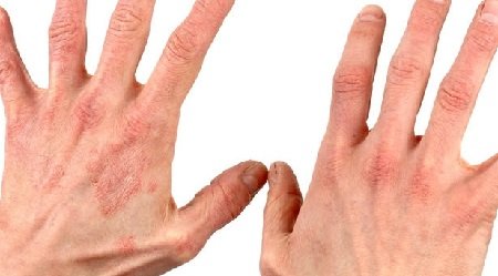 Dermatitis a kezét