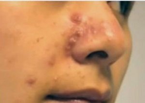 A Staphylococcus aureus az orr