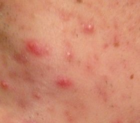 A Staphylococcus aureus az arcon