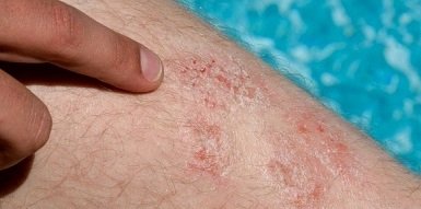 Hogyan működik a pikkelysömör