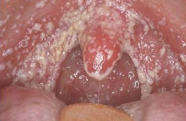 Szájüreg Candidiasis