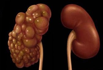 Egy vese ciszta okoz