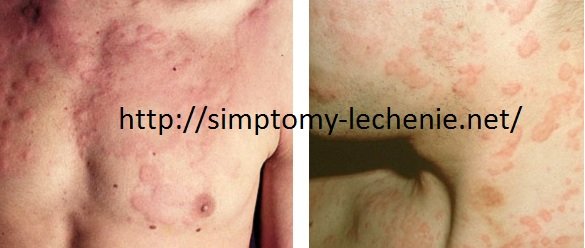 Csalánkiütés a test