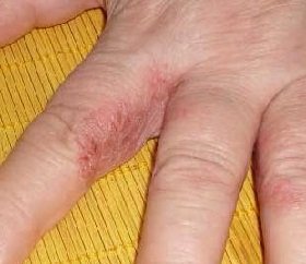 Atópiás dermatitis kezelése