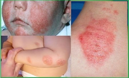 Atópiás dermatitis jelek