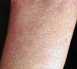 Atópiás dermatitis tünetei