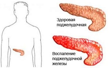 Hasnyálmirigy-gyulladás okai