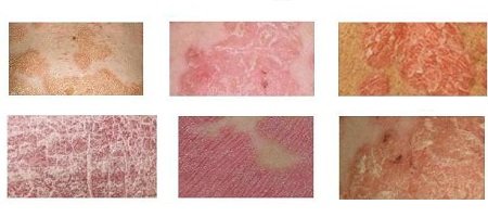 Pikkelysömör besorolás