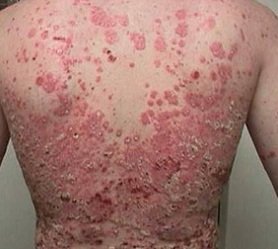 Pikkelysömör kezelése