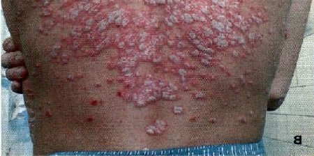 A pikkelysömör tünetei