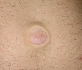 Köldöksérv tünetek