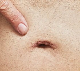 Köldöksérv felnőttek