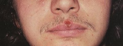 A szifilisz tünetei