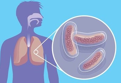 A tuberkulózis jelek