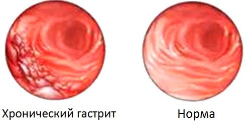 A krónikus gyomorhurut okoz