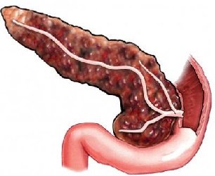 A krónikus hasnyálmirigy-gyulladás jelei