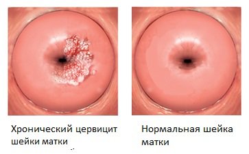 Méhnyak-gyulladás okai