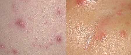 a bárányhimlő kezdet