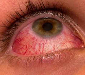 a vírusos kötőhártya-gyulladás 2