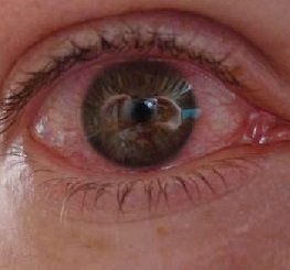 a vírusos kötőhártya-gyulladás 5