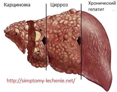 hepatitis, cirrhosis