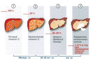 a hepatitis C